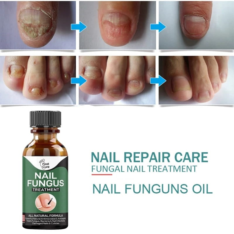 Buy 1 Get 1 Free - Nail Fungus Repairing And Treatment Oil
