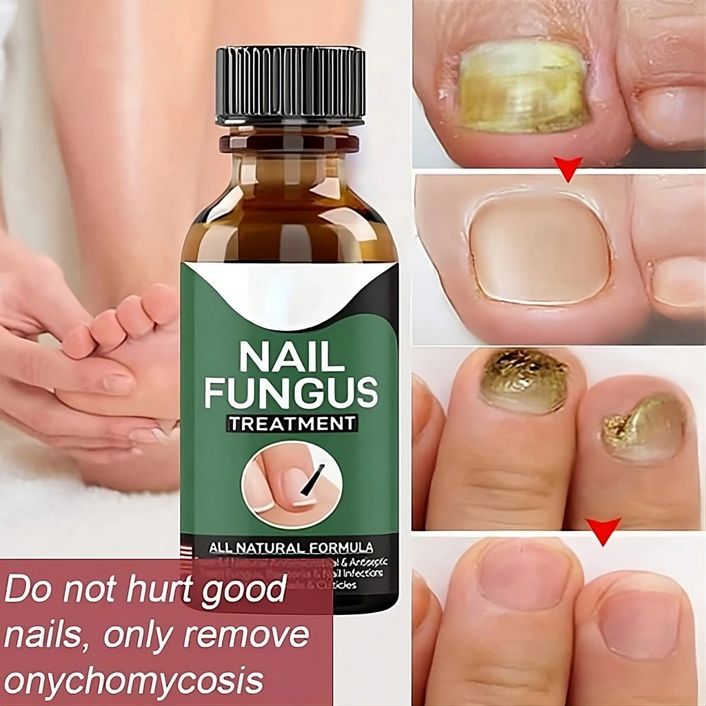 Nail Fungus Repairing And Treatment Oil - (Overall Money Back Guarantee) - Miraaj
