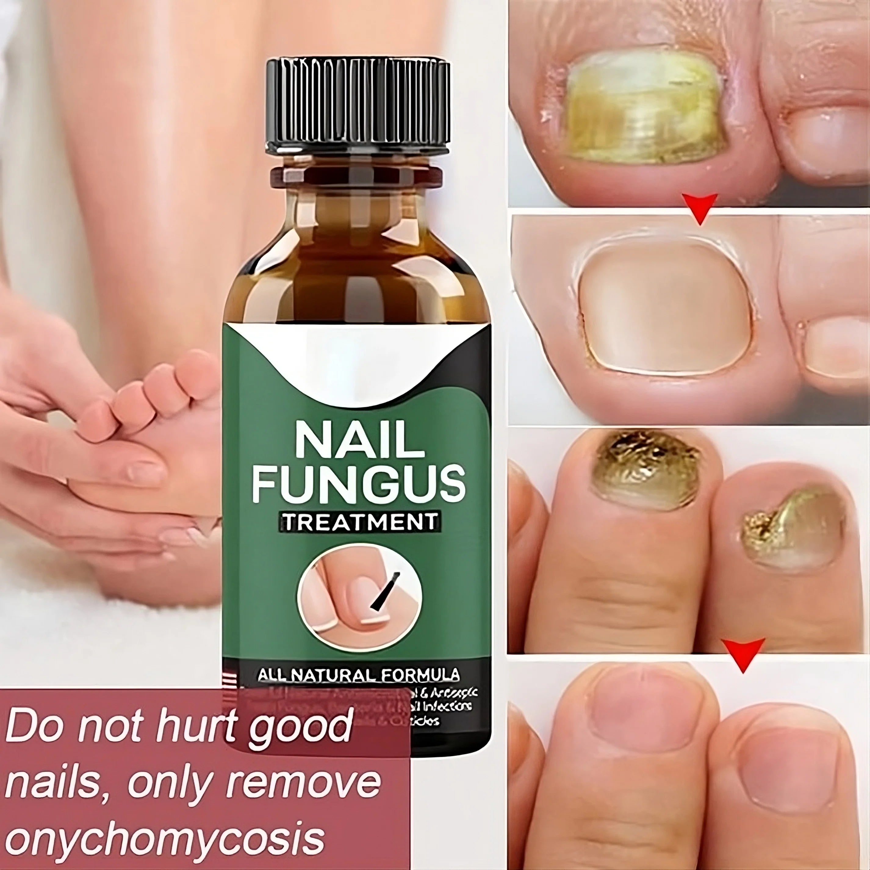 Nail Fungus Repairing And Treatment Oil - (Overall Money Back Guarantee) - Miraaj