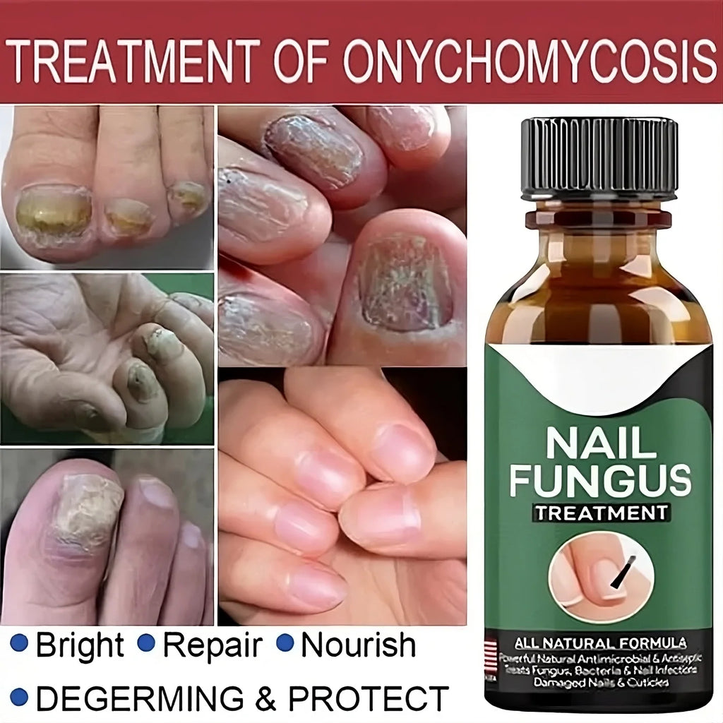 Nail Fungus Repairing And Treatment Oil - (Overall Money Back Guarantee) - Miraaj