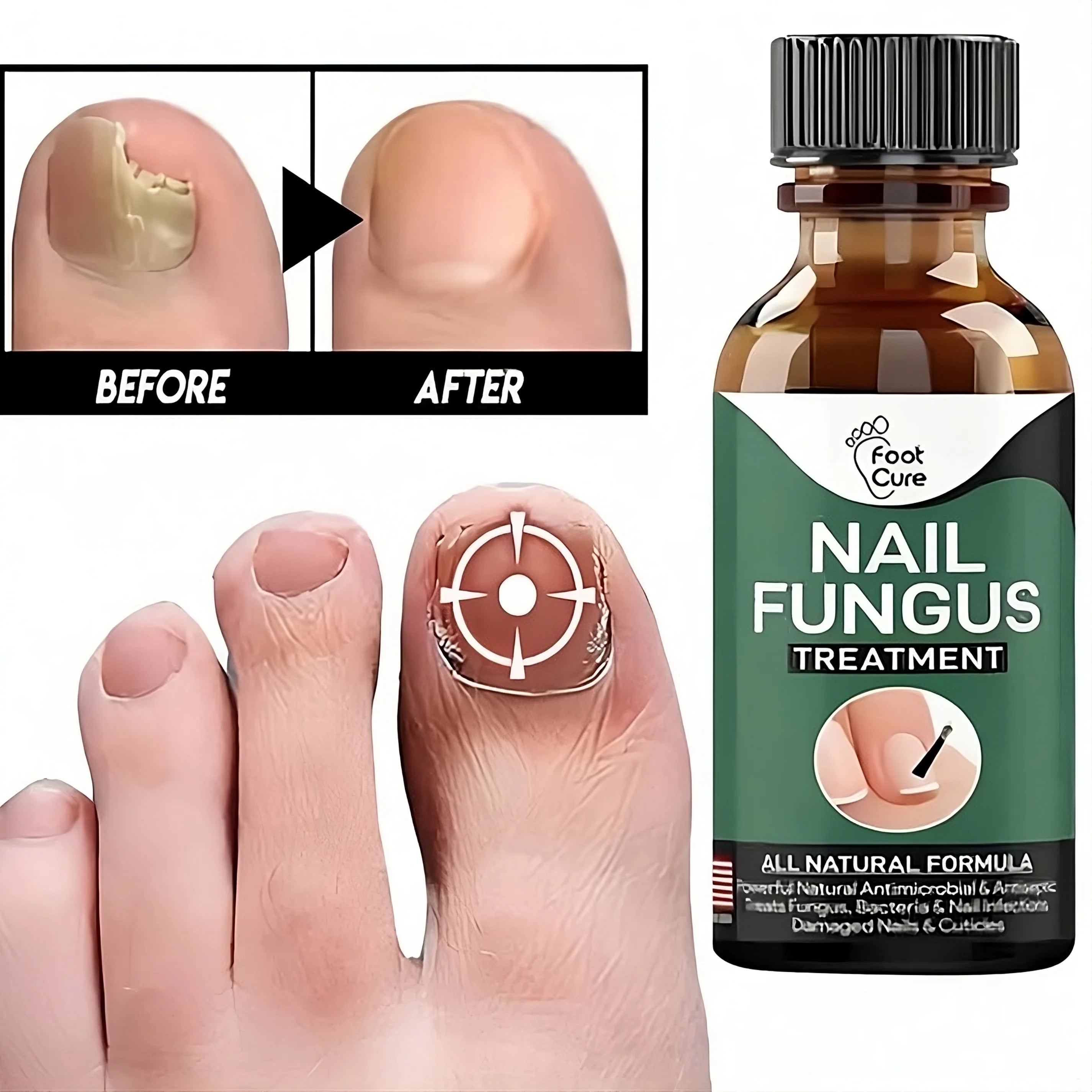 Nail Fungus Repairing And Treatment Oil - (Overall Money Back Guarantee) - Miraaj